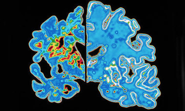 Le point sur les techniques et les méthodes pour le diagnostic d'Alzheimer
