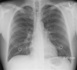 Cancers du poumons : la piste du dépistage obligatoire