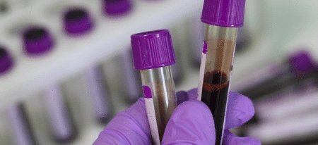 En Chine, des chercheurs développent une analyse cutanée du taux de cholestérol