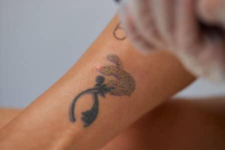 Le détatouage : comprendre comment ça se passe et ce que ça implique