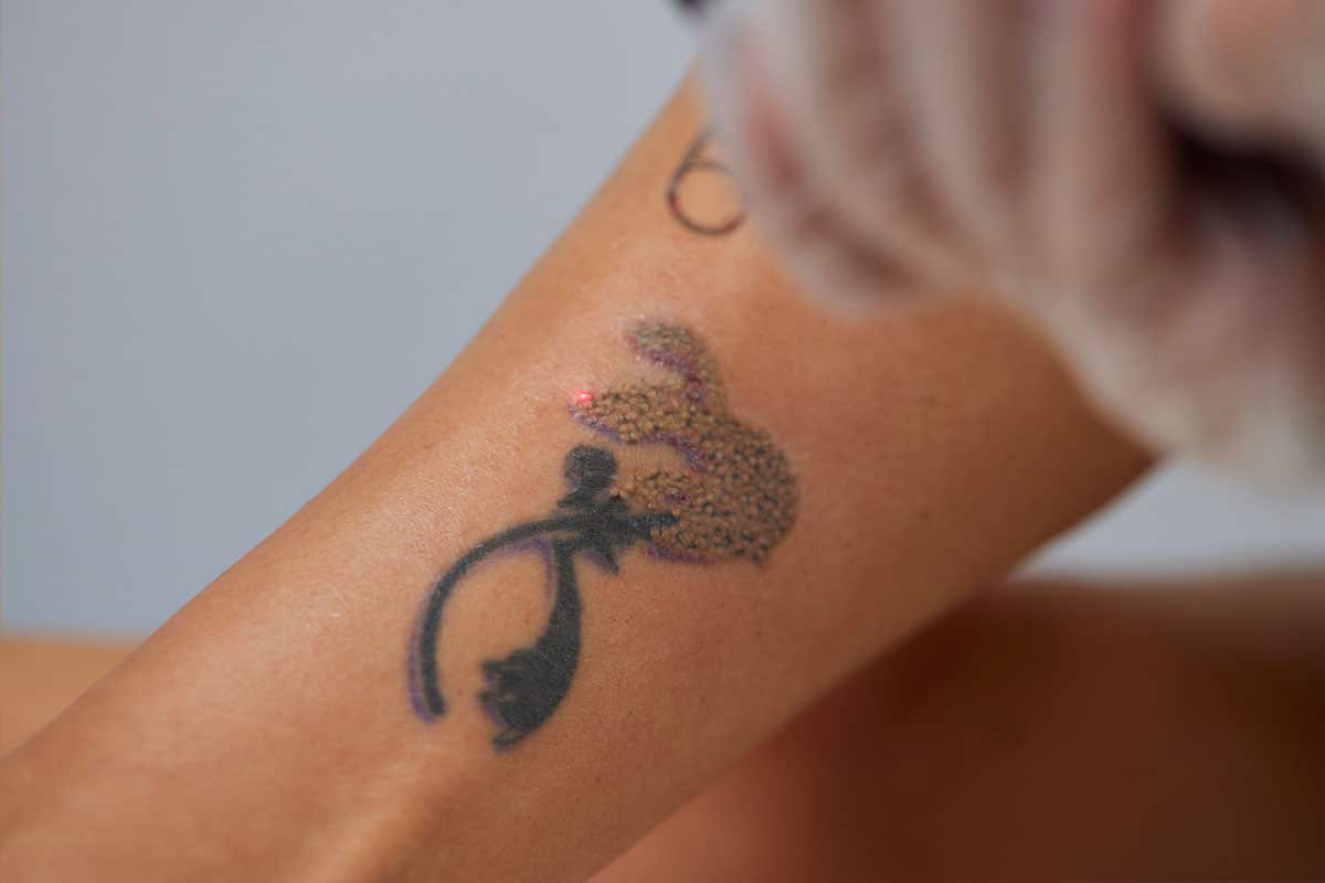 Le détatouage : comprendre comment ça se passe et ce que ça implique