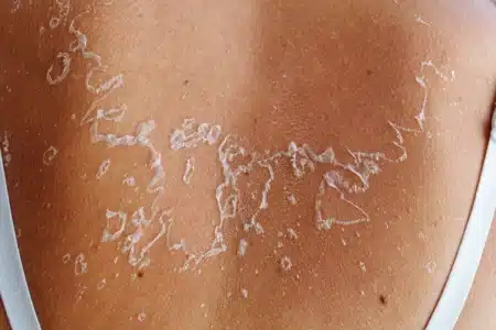 Comprendre et gérer la desquamation après un coup de soleil